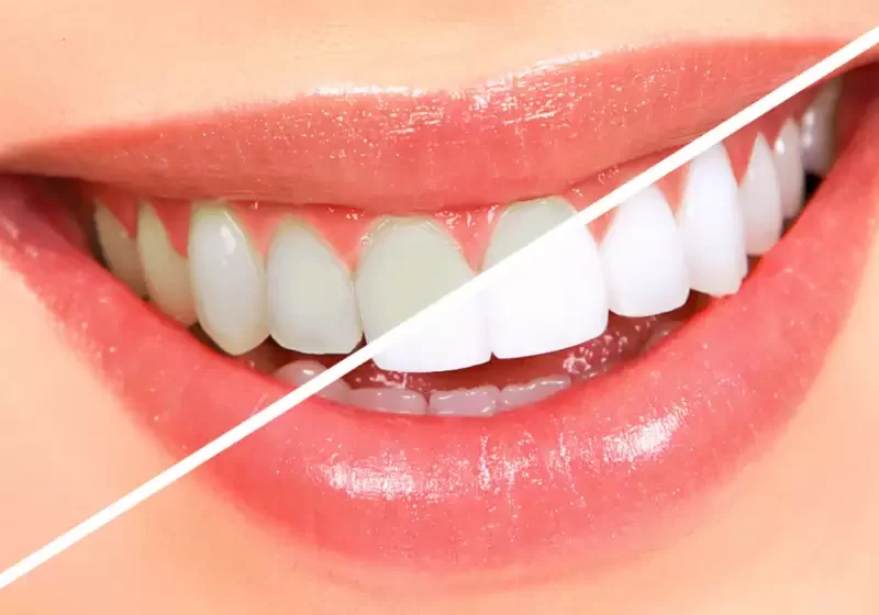  Should You Whiten Your Teeth at Home?