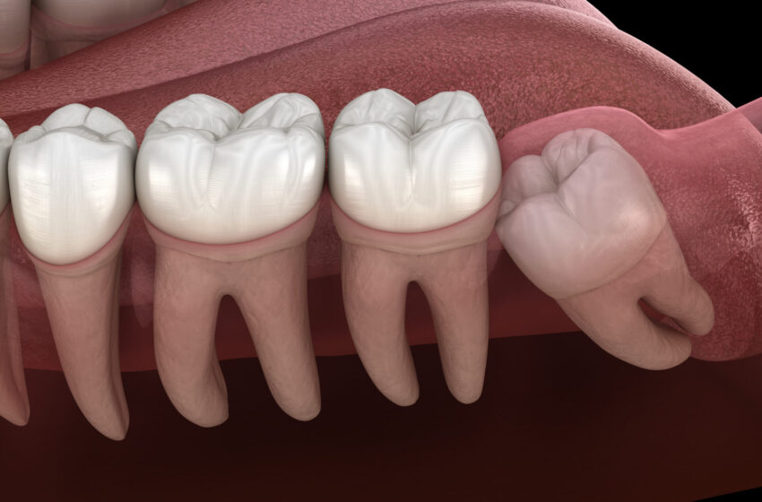 3 Signs To Look Out to Know If You Need a Tooth Pulled