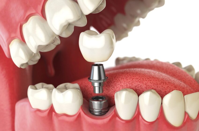  Your Journey Of Dental Implants: Exploring Their Efficiency 