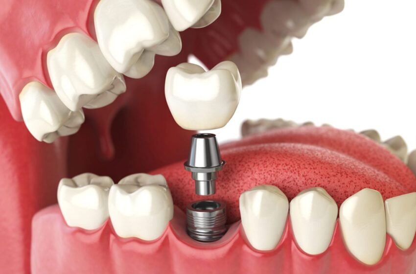 Your Journey Of Dental Implants: Exploring Their Efficiency