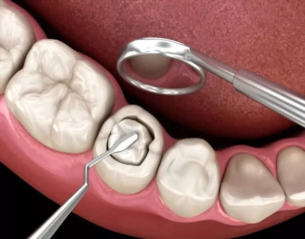  The Unseen Advantages Of Composite Fillings 