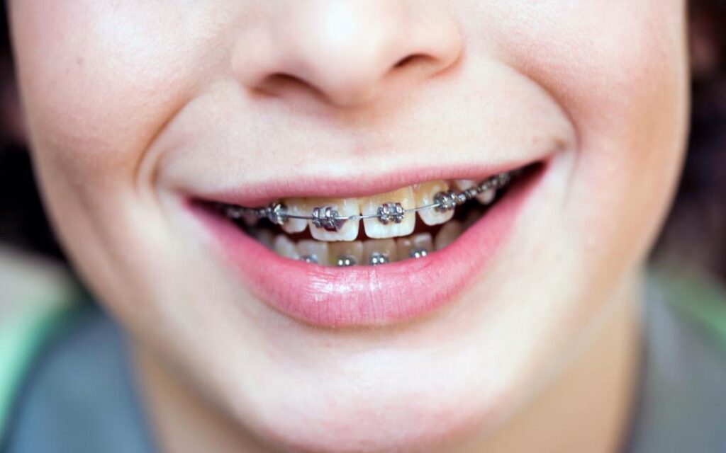 What is the Right Age for Braces?